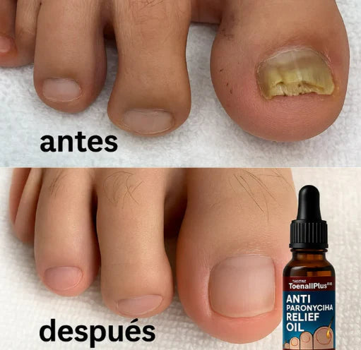 Suero Anti Hongos